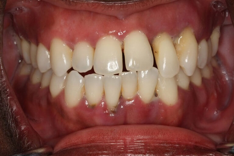 Periodontal Disease Britten Perio