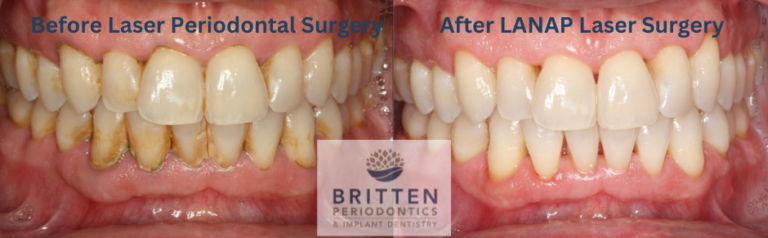 Laser Periodontal Surgery Before And After Britten Perio