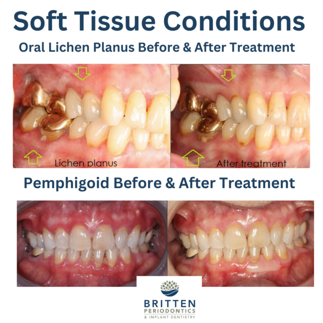 Soft Tissue Conditions Before And After Treatment Britten Perio