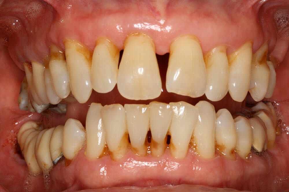 Let's talk about permanent, non-removable teeth replacement options –  Britten Perio