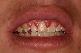 A moderate case of gingival hyperplasia
