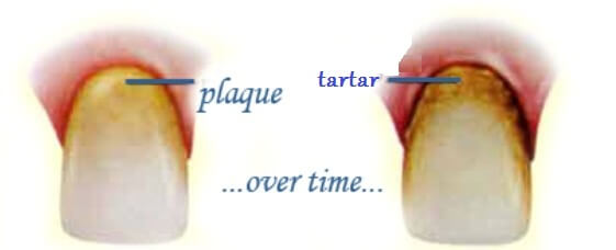 Plaque vs. Tartar
