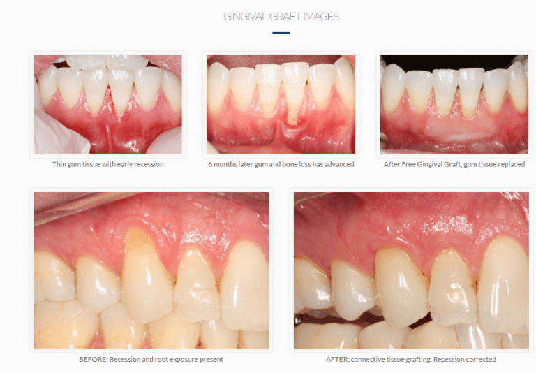 This is what happens when your gums are receding – Britten Perio