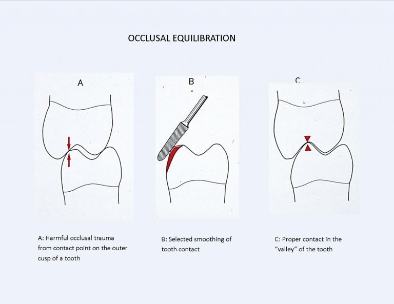 what-is-occlusal-therapy-and-how-can-it-improve-gum-health-britten-perio