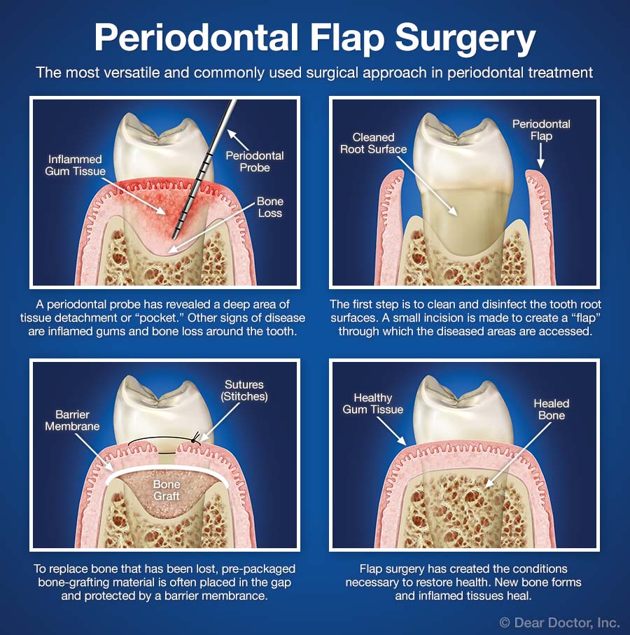 what-you-need-to-know-about-periodontal-flap-surgery-britten-perio