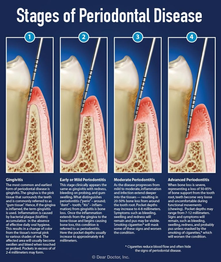 What are the stages of gum disease? Britten Perio
