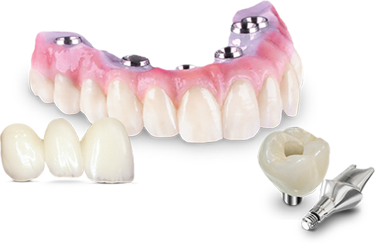 Let's talk about permanent, non-removable teeth replacement options –  Britten Perio