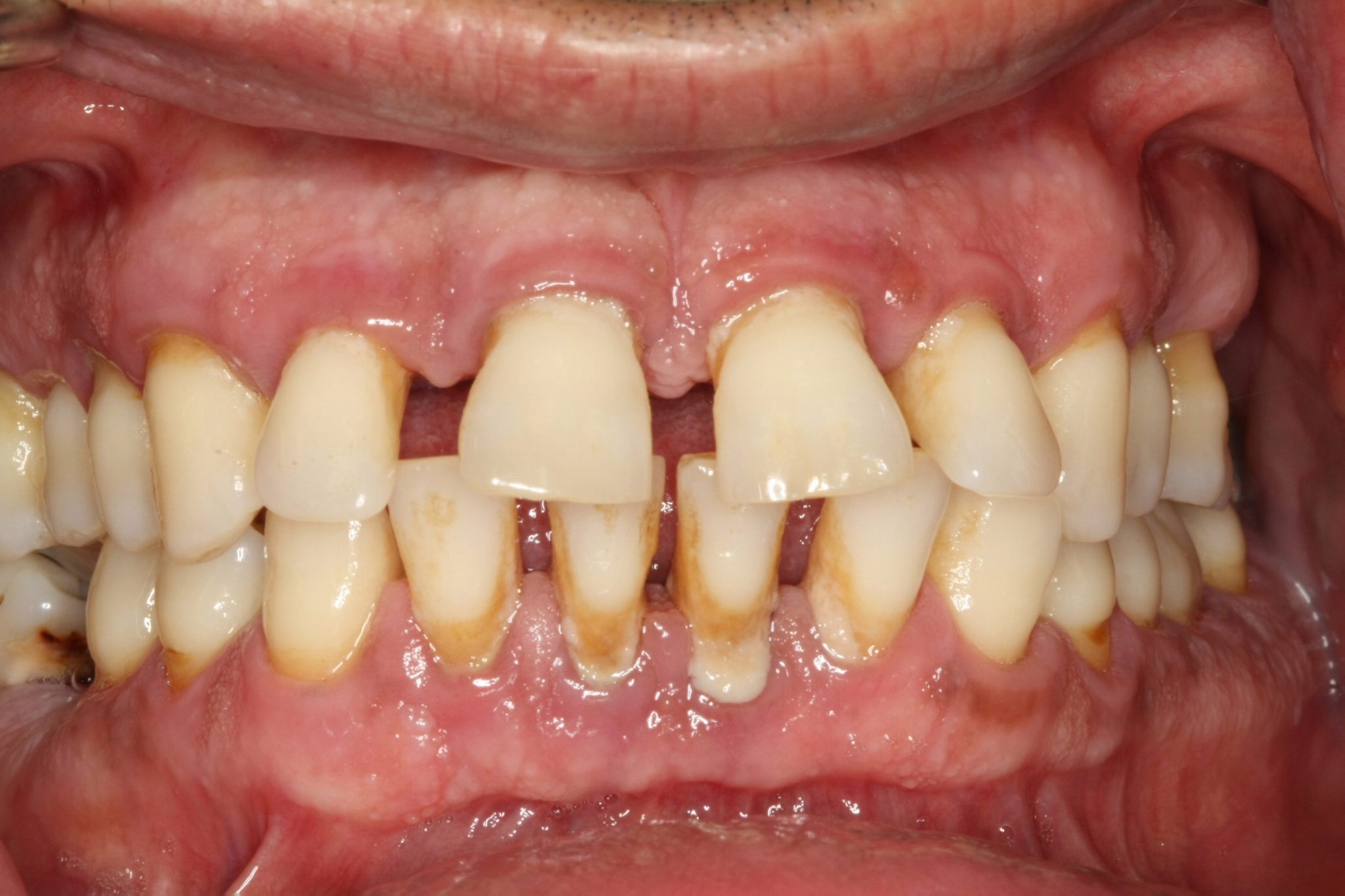 New Study Links Gum Disease And Covid‐19 Complications Britten Perio
