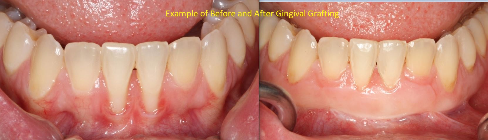 Soft Tissue Grafting What To Know Britten Perio