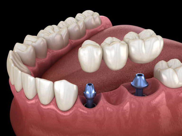 What Are Your Implant Options? – Britten Perio