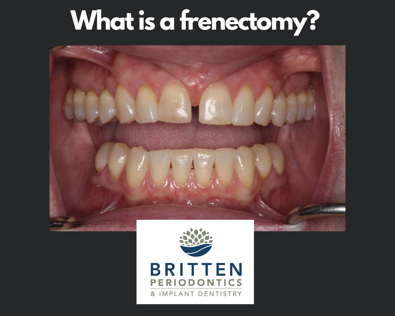 Occlusal therapy why our bite is important Britten Perio