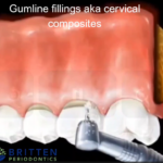 Illustration of a gumline filling placed at the junction of tooth and gum to repair erosion or damage.