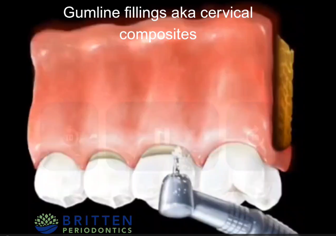 Illustration of a gumline filling placed at the junction of tooth and gum to repair erosion or damage.