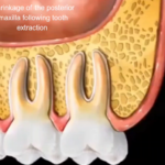 Animation showing bone loss in the posterior maxilla after tooth extractions without grafting.