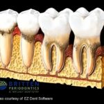 Diagram showing how gum disease progresses, starting with plaque buildup and advancing to bone loss and tooth loss.
