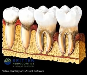 Diagram showing how gum disease progresses, starting with plaque buildup and advancing to bone loss and tooth loss.