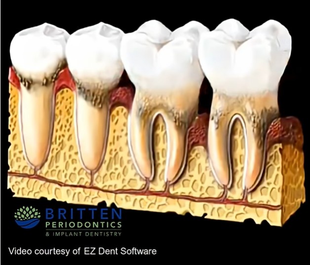 Diagram showing how gum disease progresses, starting with plaque buildup and advancing to bone loss and tooth loss.