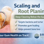 Scaling and root planing procedure shown cleaning below the gumline to remove tartar and bacteria, from Britten Periodontics