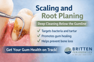 Scaling and root planing procedure shown cleaning below the gumline to remove tartar and bacteria, from Britten Periodontics