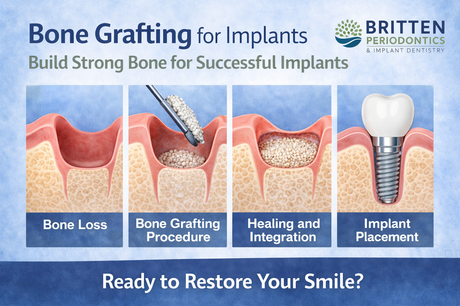 Diagram showing the stages of bone grafting for dental implants, including bone loss, bone graft placement, healing and integration, and implant placement in regenerated bone.