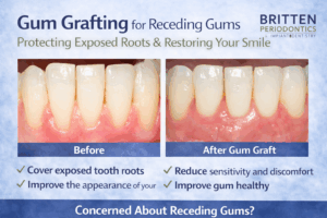 Side-by-side clinical photos of lower front teeth before and after gum grafting, showing improved gum coverage and reduced recession.