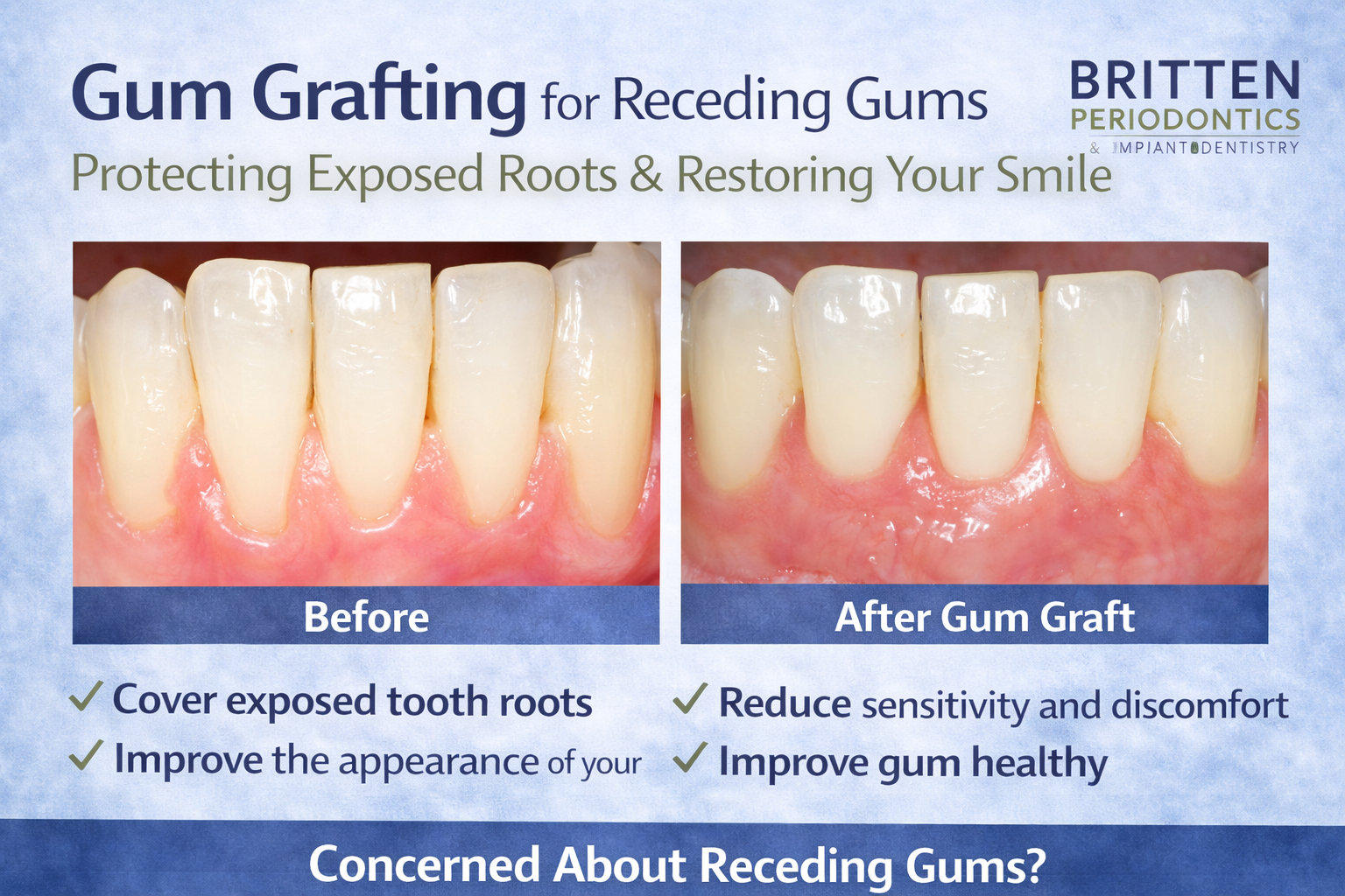 Side-by-side clinical photos of lower front teeth before and after gum grafting, showing improved gum coverage and reduced recession.