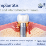 Illustration showing peri-implantitis with inflammation and bone loss around a dental implant, featuring the Britten Periodontics and Implant Dentistry logo.