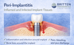 Illustration showing peri-implantitis with inflammation and bone loss around a dental implant, featuring the Britten Periodontics and Implant Dentistry logo.