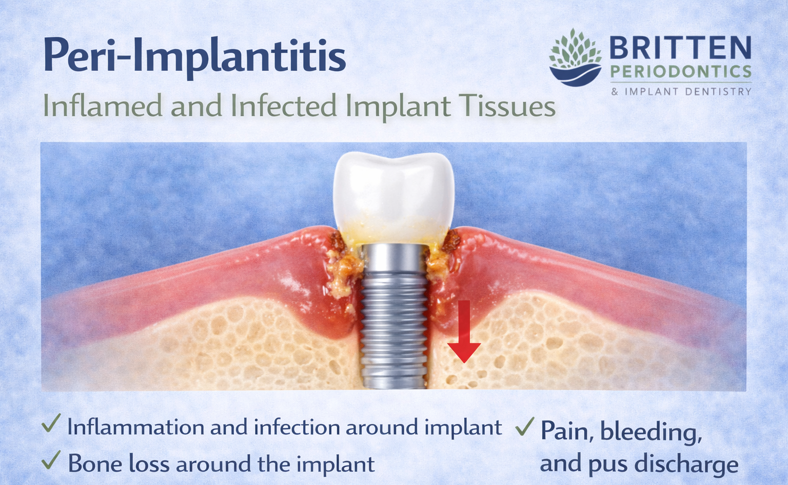 Illustration showing peri-implantitis with inflammation and bone loss around a dental implant, featuring the Britten Periodontics and Implant Dentistry logo.