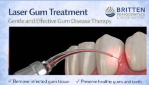 Dental laser used to treat infected gum tissue around teeth as part of laser gum disease treatment, featuring the Britten Periodontics and Implant Dentistry logo.