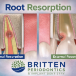 Photos showing root resorption in tooth