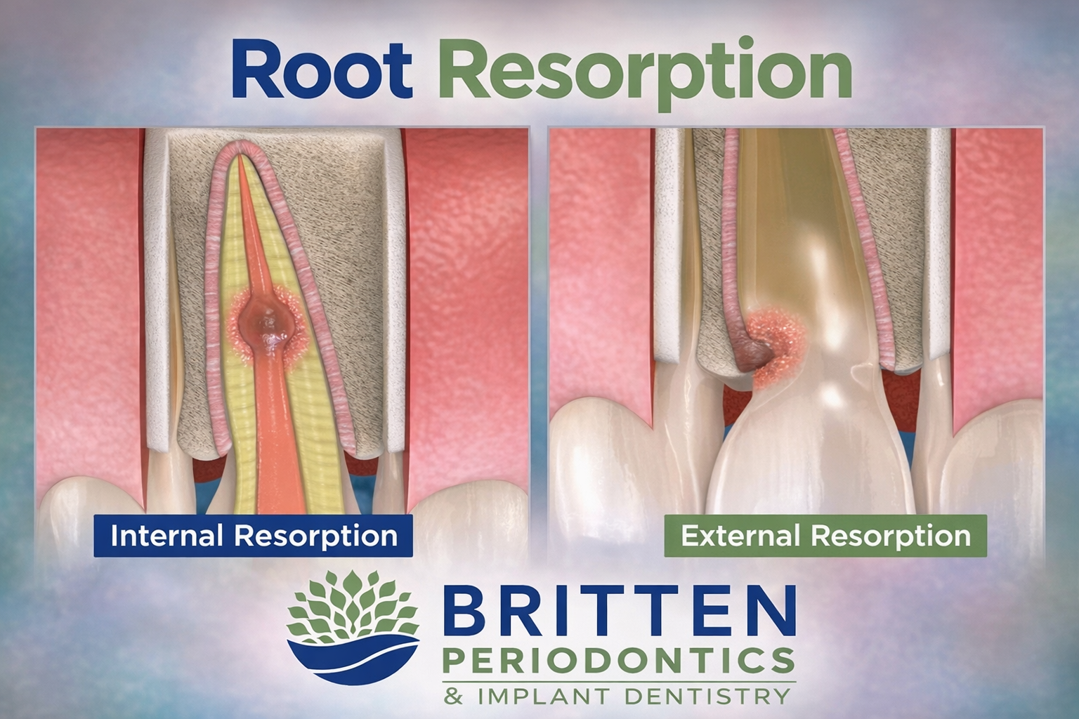 Photos showing root resorption in tooth