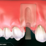 immediate implant placement with bone graft in healthy socket