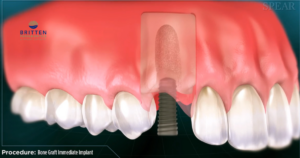 immediate implant placement with bone graft in healthy socket